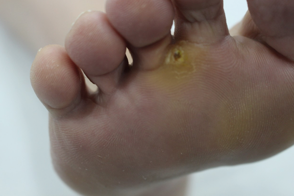 pie sin verruga plantar entre 2 dedos con tratamiento láser en Alicante