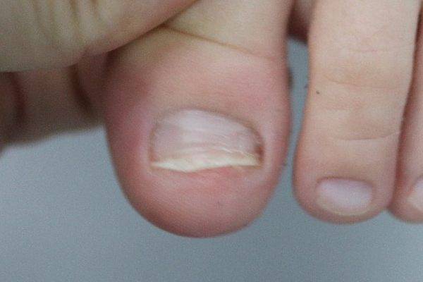 dedo sin verruga plantar después del tratamiento