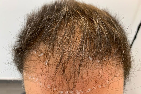 Tecnica F.U.E. sin rasurar contra la alopecia