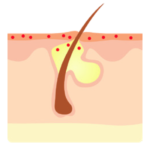 aparición del acné 1