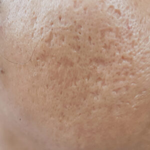 Marcas de acné