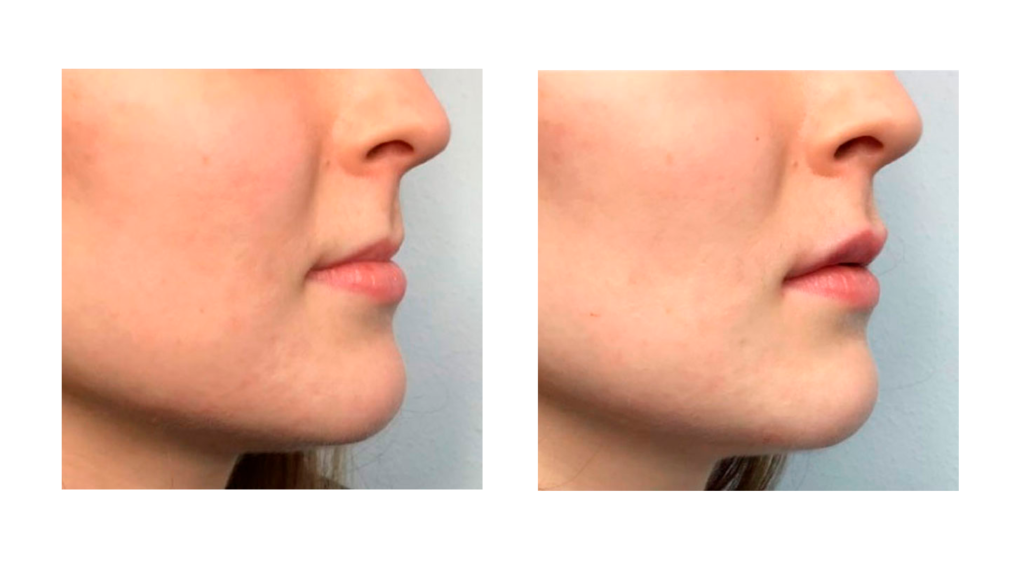 tratamiento de labios con Ácido Hialurónico. Antes y después.