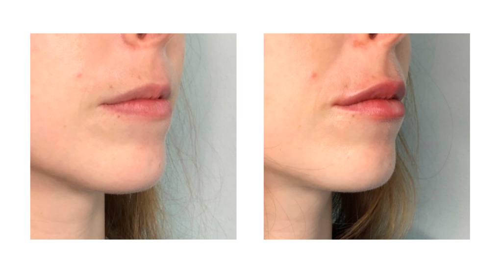 tratamiento de labios con Ácido Hialurónico. Antes y después.