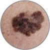 Melanoma maligno